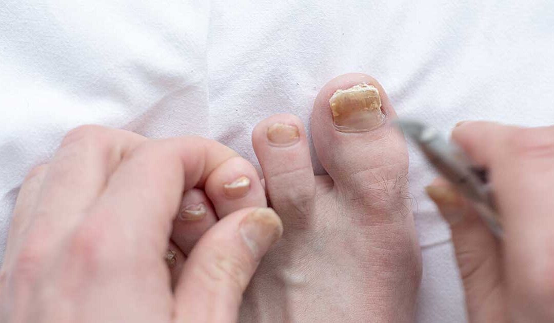 Nail Treatment Revolution