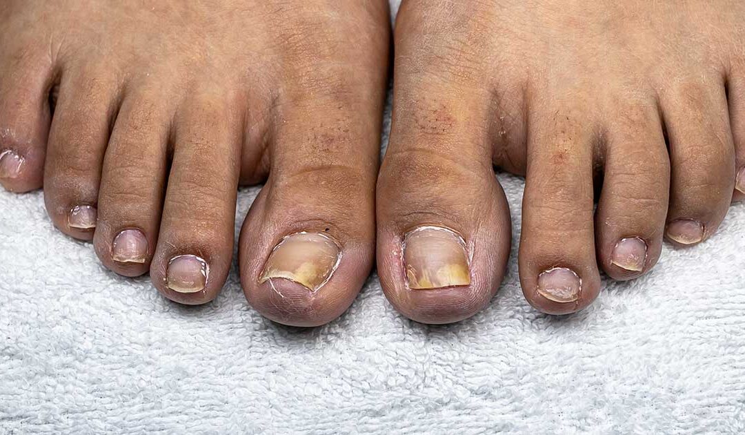 What could be nail infection?