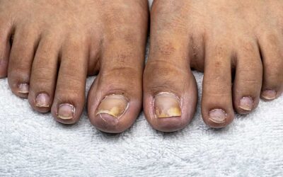 What could be nail infection?